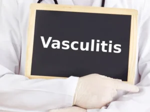 o que são as vasculites?